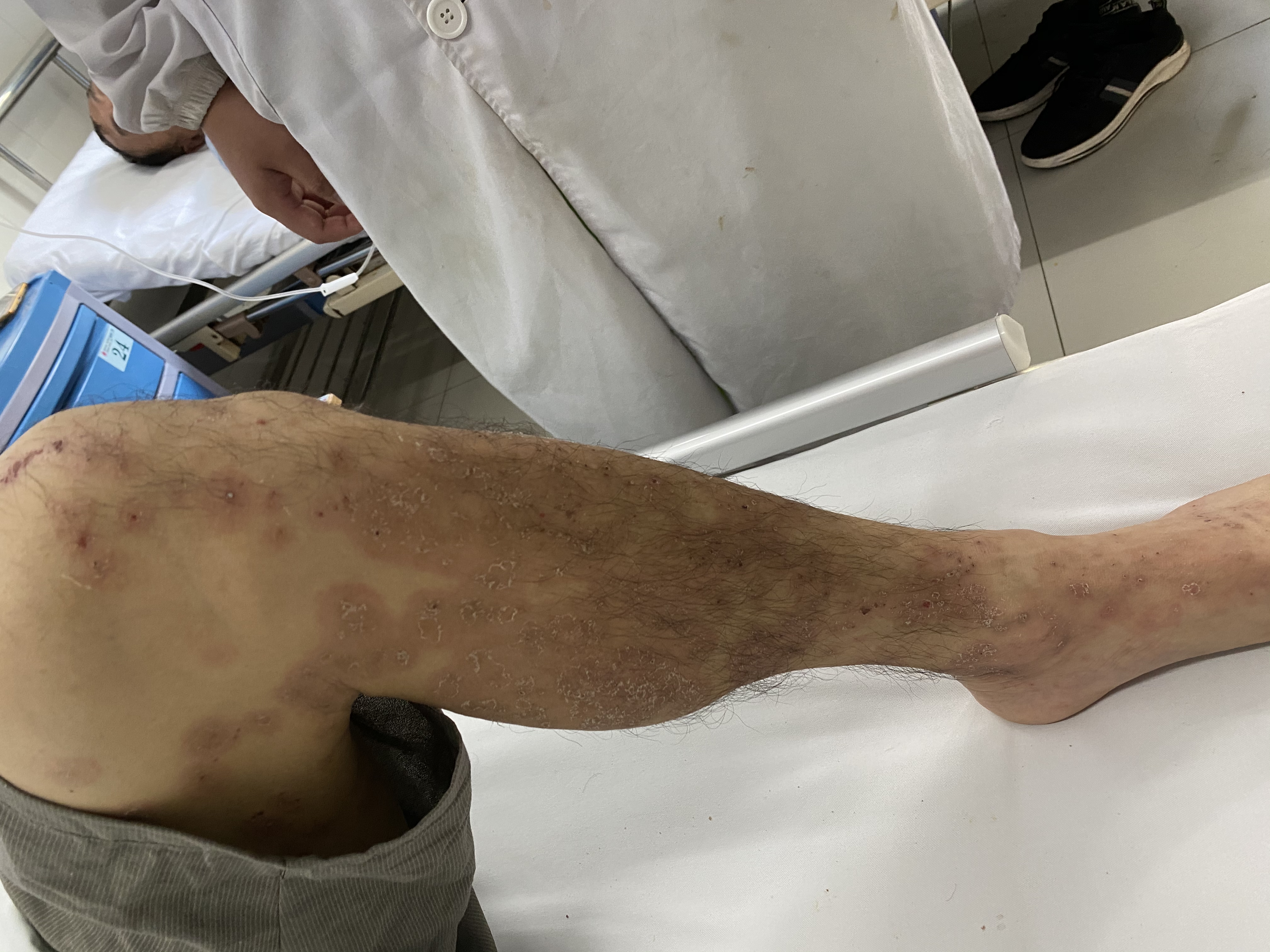接诊医生胡聪龙在给患者进行了一系列的检查后,诊断他为过敏性皮疹.