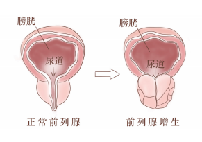 为什么男性容易得前列腺增生？.jpg