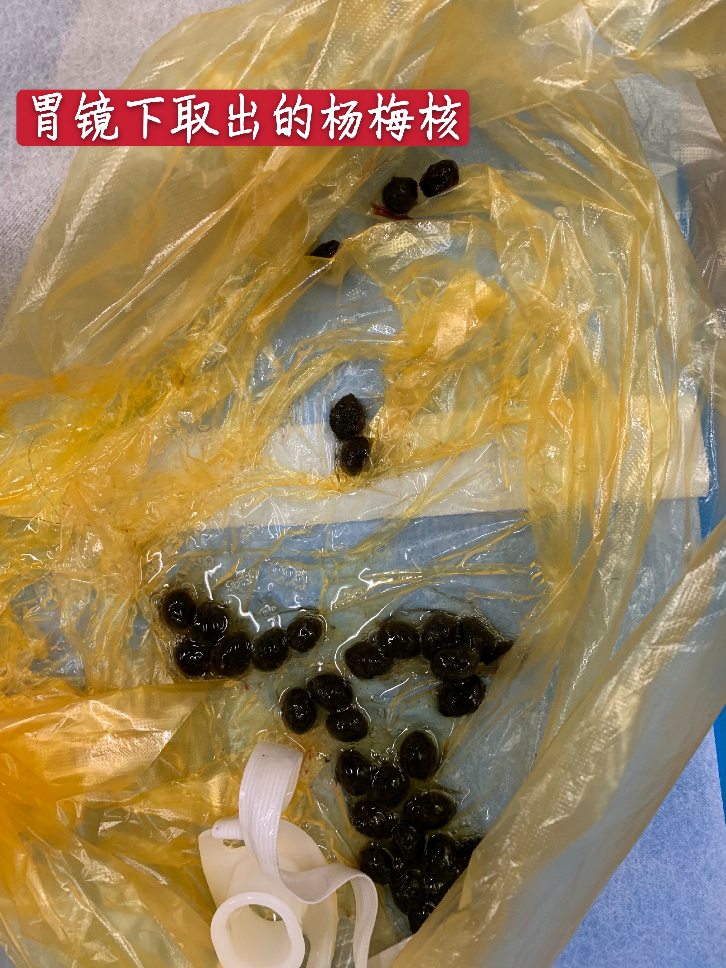 胃镜下取出的杨梅核.jpg