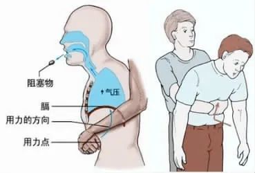 当心儿童气道异物窒息3.jpg