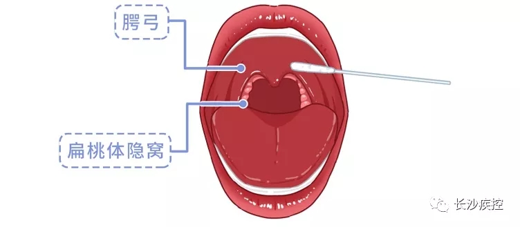 口咽拭子.webp.jpg