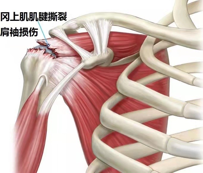 肩痛患者须及时明确病因对症治疗 (2).jpg