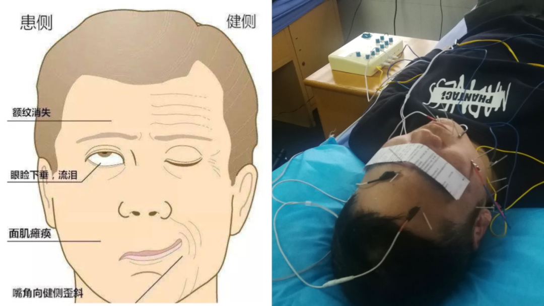 一觉醒来口角歪斜当心是面瘫.png