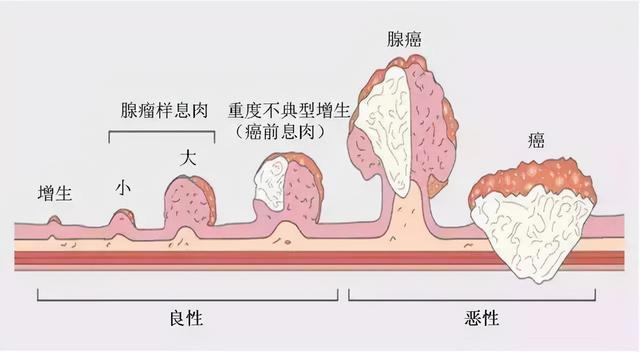 肠息肉切除后警惕术后并发症.png